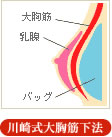 川崎式大胸筋下法 