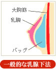 一般的な乳腺下法