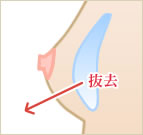 豊胸術バッグ抜去