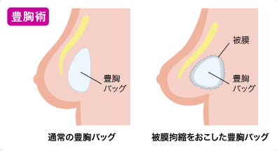 豊胸手術 術後の被膜拘縮（カプセル拘縮）イラスト