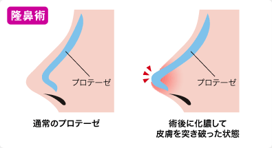 豊胸手術 術後の被膜拘縮（カプセル拘縮）イラスト